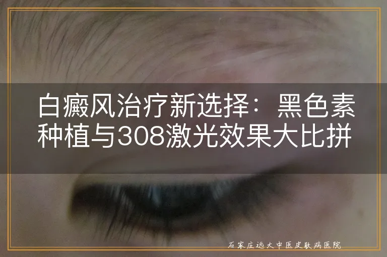 白癜风治疗新选择：黑色素种植与308激光效果大比拼