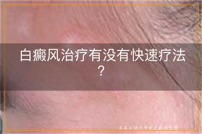 白癜风治疗有没有快速疗法？