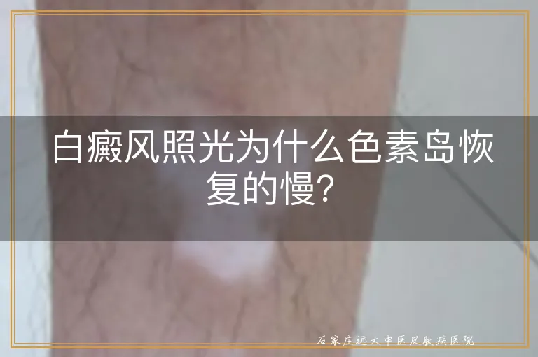 白癜风照光为什么色素岛恢复的慢？