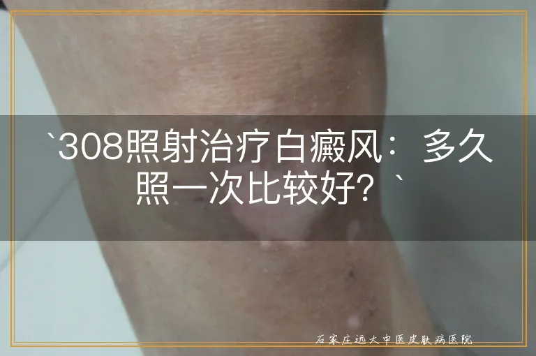 `308照射治疗白癜风：多久照一次比较好？`