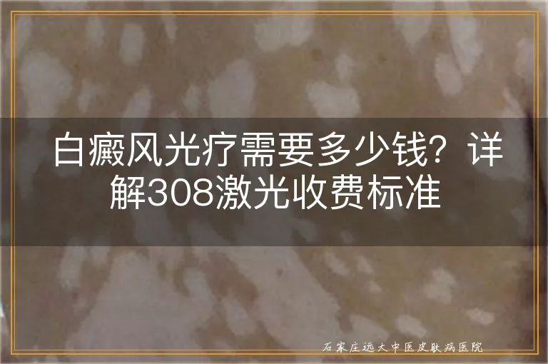 白癜风光疗需要多少钱？详解308激光收费标准