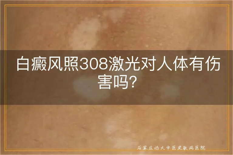 白癜风照308激光对人体有伤害吗？