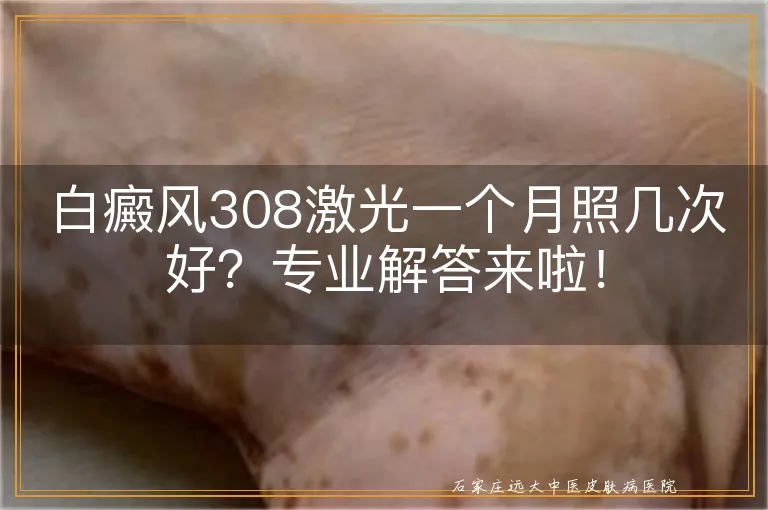 白癜风308激光一个月照几次好？专业解答来啦！