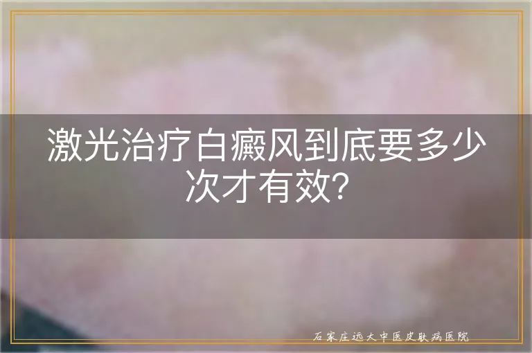 激光治疗白癜风到底要多少次才有效？