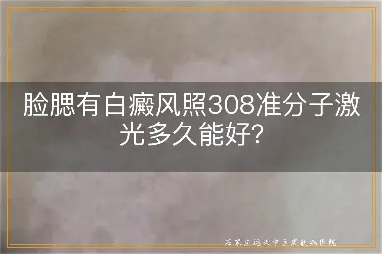 脸腮有白癜风照308准分子激光多久能好？