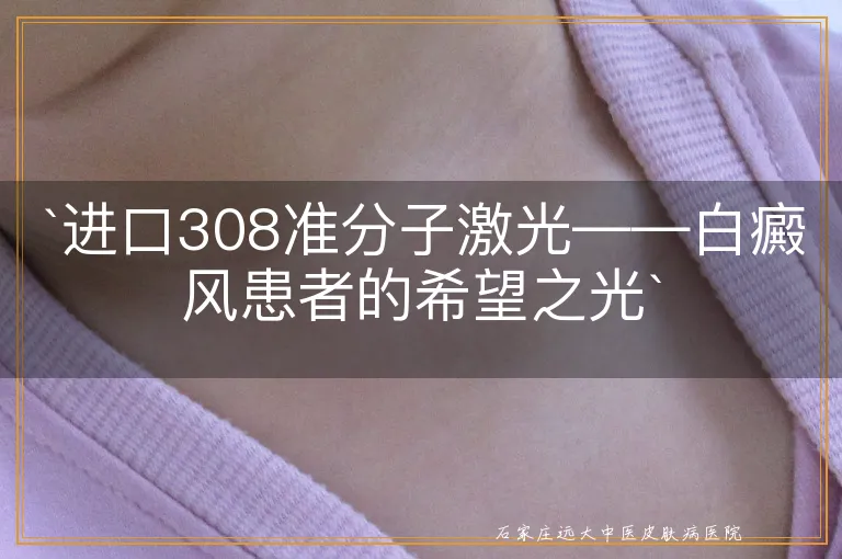 `进口308准分子激光——白癜风患者的希望之光`