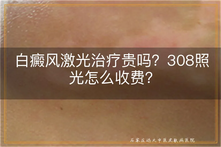 白癜风激光治疗贵吗？308照光怎么收费？