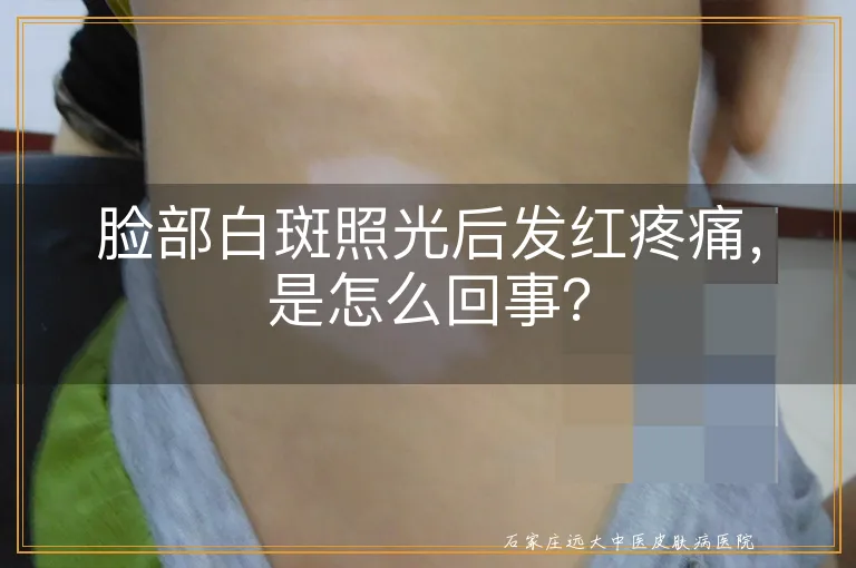 脸部白斑照光后发红疼痛，是怎么回事？