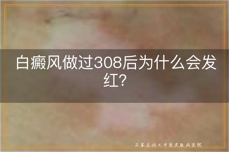 白癜风做过308后为什么会发红？