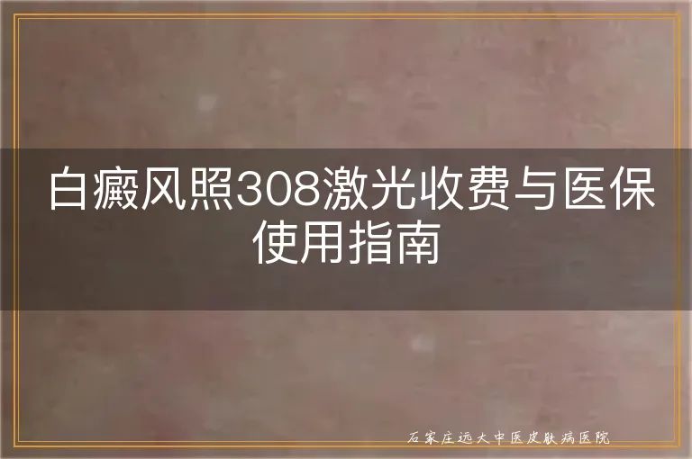 白癜风照308激光收费与医保使用指南