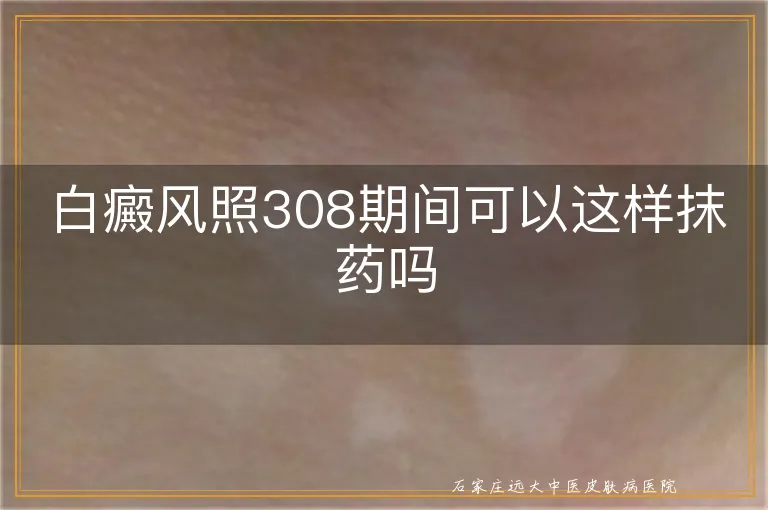 白癜风照308期间可以这样抹药吗