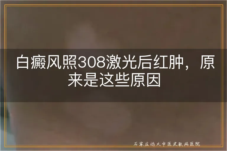 白癜风照308激光后红肿，原来是这些原因