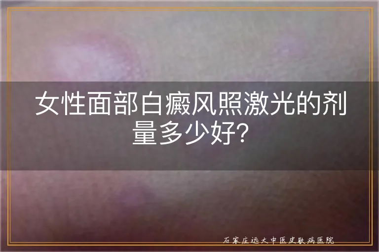 女性面部白癜风照激光的剂量多少好？