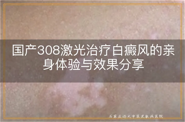 国产308激光治疗白癜风的亲身体验与效果分享