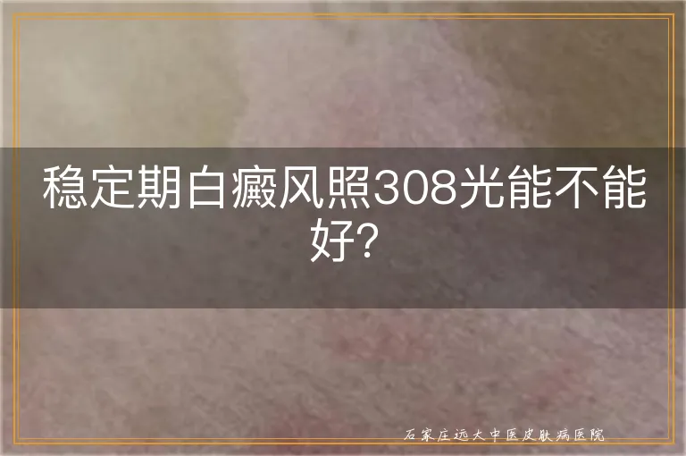 稳定期白癜风照308光能不能好？