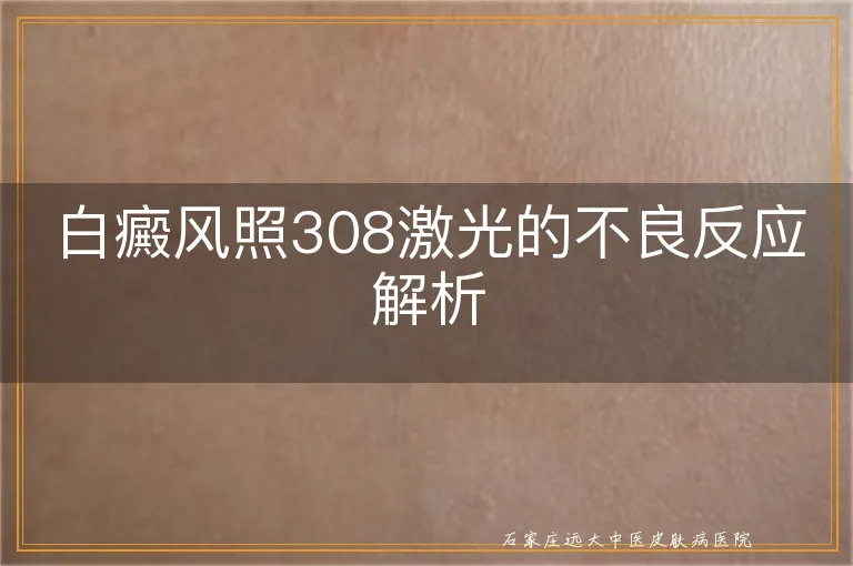 白癜风照308激光的不良反应解析