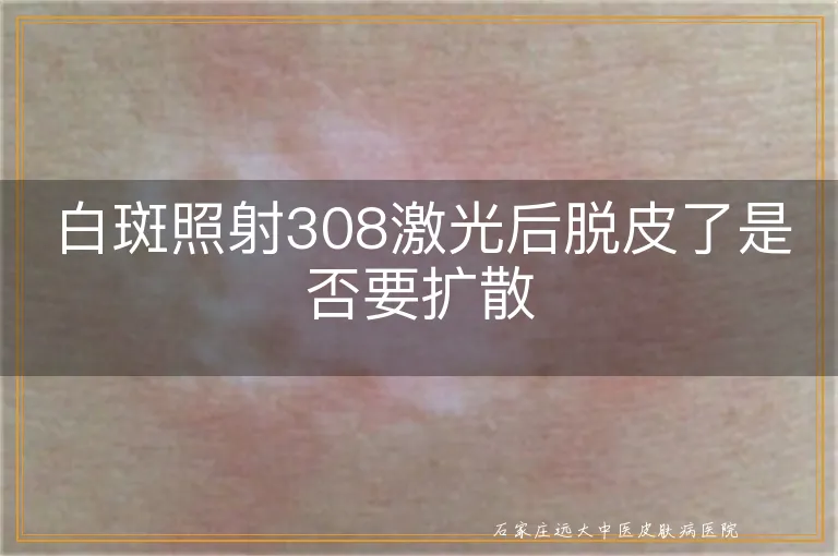 白斑照射308激光后脱皮了是否要扩散