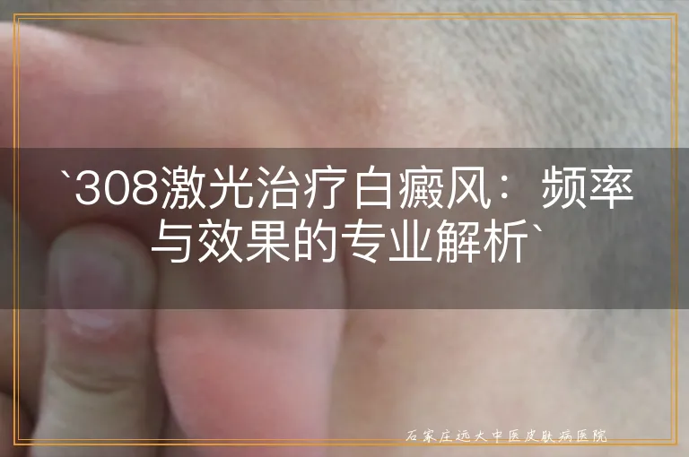 `308激光治疗白癜风：频率与效果的专业解析`