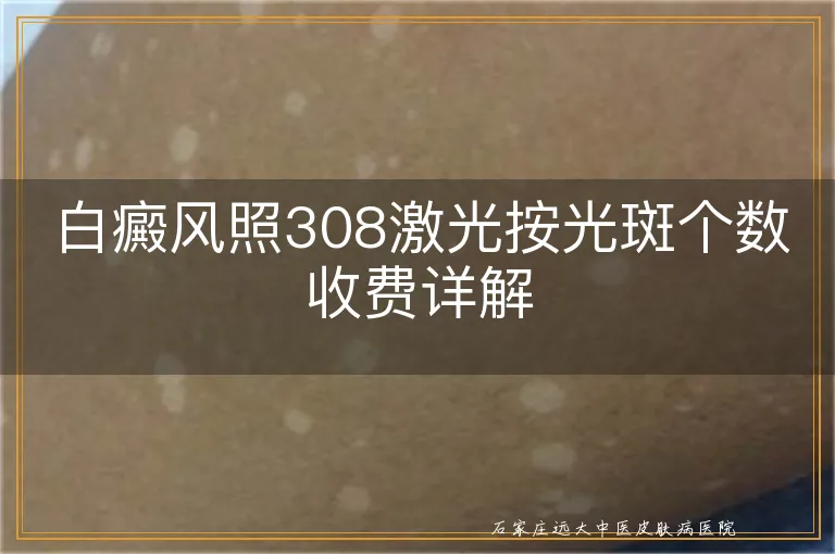 白癜风照308激光按光斑个数收费详解