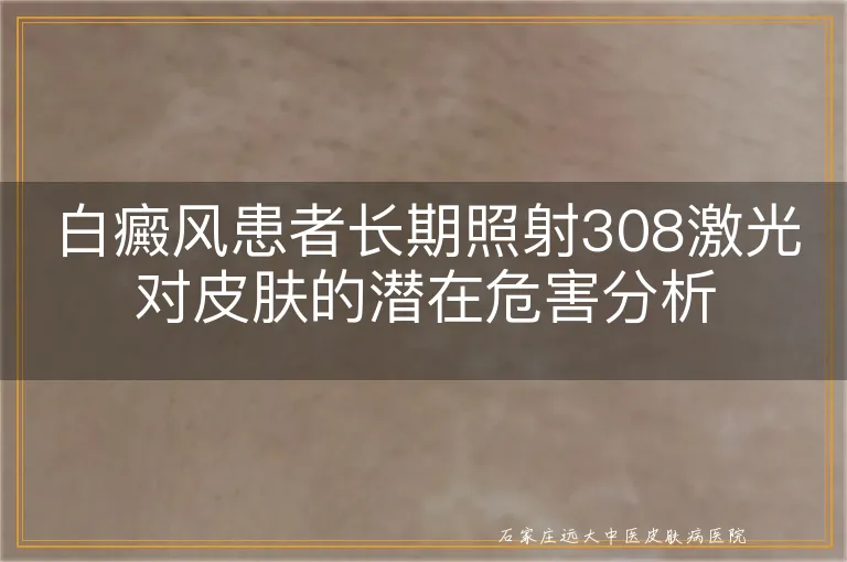 白癜风患者长期照射308激光对皮肤的潜在危害分析