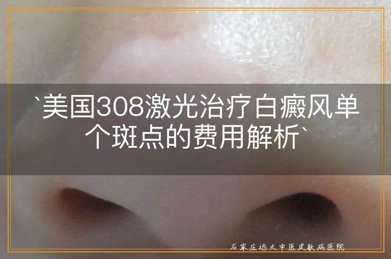 `美国308激光治疗白癜风单个斑点的费用解析`