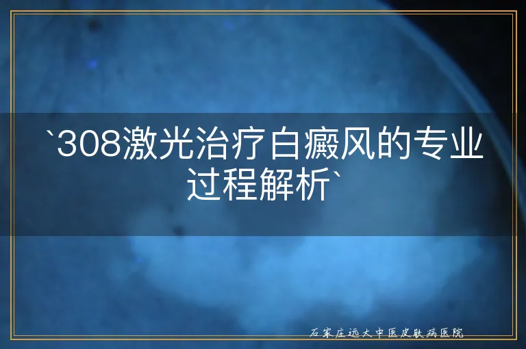 `308激光治疗白癜风的专业过程解析`