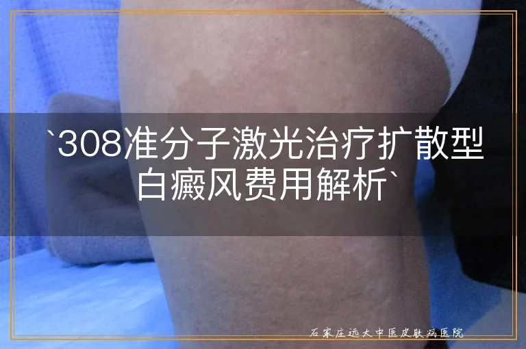 `308准分子激光治疗扩散型白癜风费用解析`