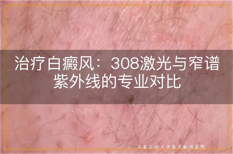 治疗白癜风：308激光与窄谱紫外线的专业对比