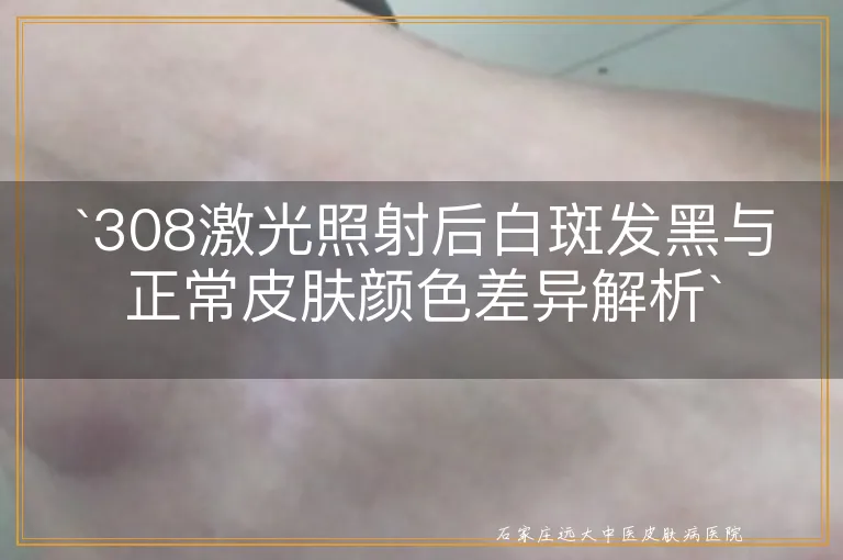 `308激光照射后白斑发黑与正常皮肤颜色差异解析`