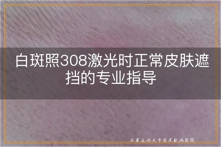 白斑照308激光时正常皮肤遮挡的专业指导