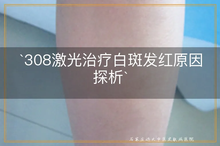 `308激光治疗白斑发红原因探析`