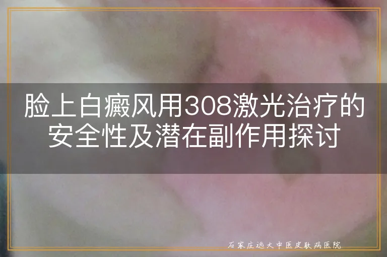 脸上白癜风用308激光治疗的安全性及潜在副作用探讨