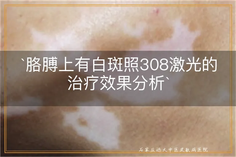 `胳膊上有白斑照308激光的治疗效果分析`