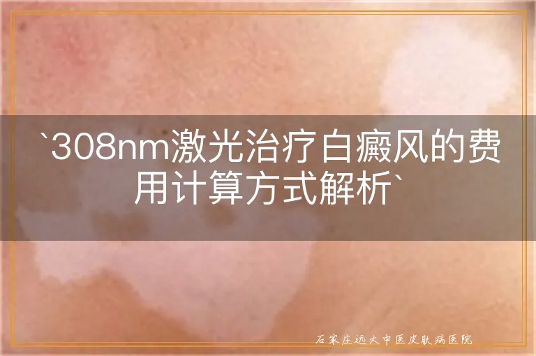 `308nm激光治疗白癜风的费用计算方式解析`