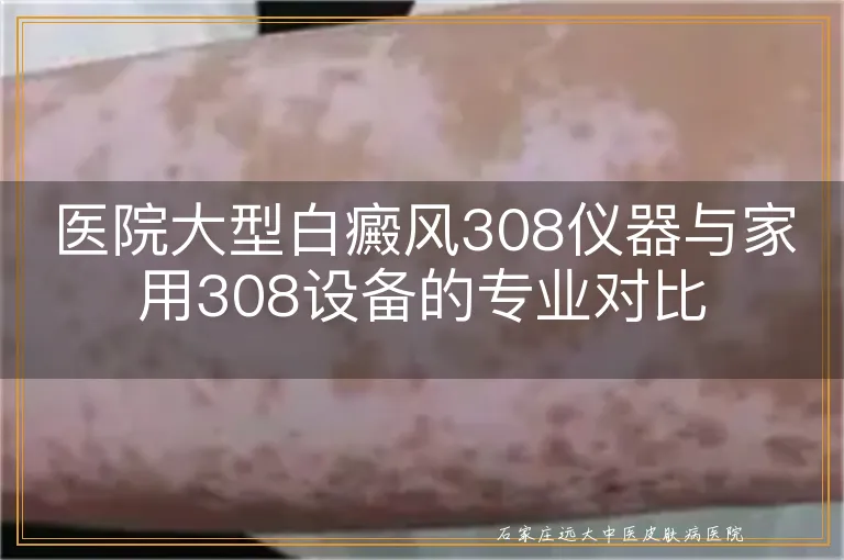 医院大型白癜风308仪器与家用308设备的专业对比