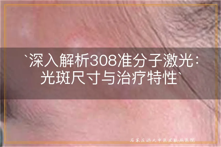 `深入解析308准分子激光：光斑尺寸与治疗特性`