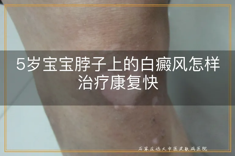 5岁宝宝脖子上的白癜风怎样治疗康复快