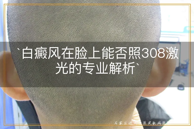 `白癜风在脸上能否照308激光的专业解析`