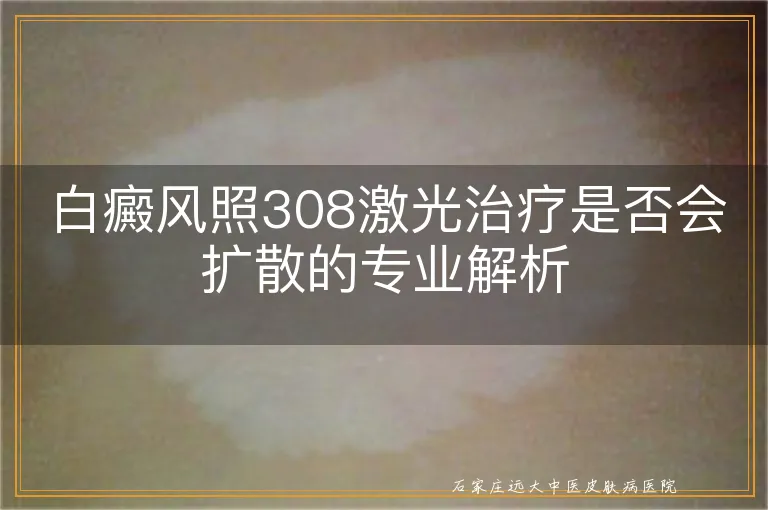 白癜风照308激光治疗是否会扩散的专业解析