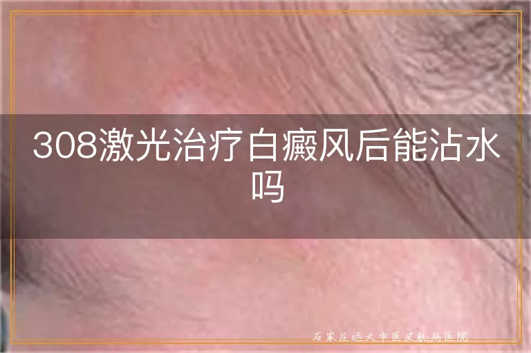 308激光治疗白癜风后能沾水吗