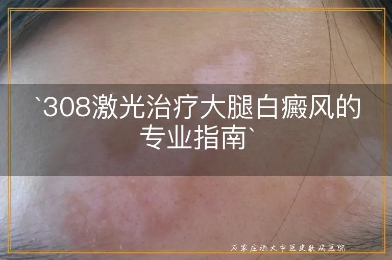 `308激光治疗大腿白癜风的专业指南`