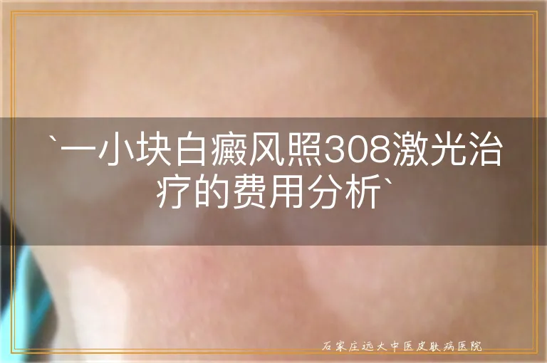 `一小块白癜风照308激光治疗的费用分析`