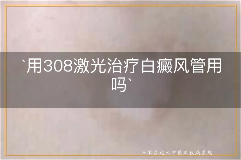 `用308激光治疗白癜风管用吗`