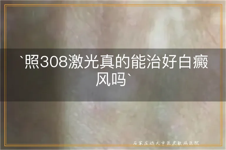 `照308激光真的能治好白癜风吗`