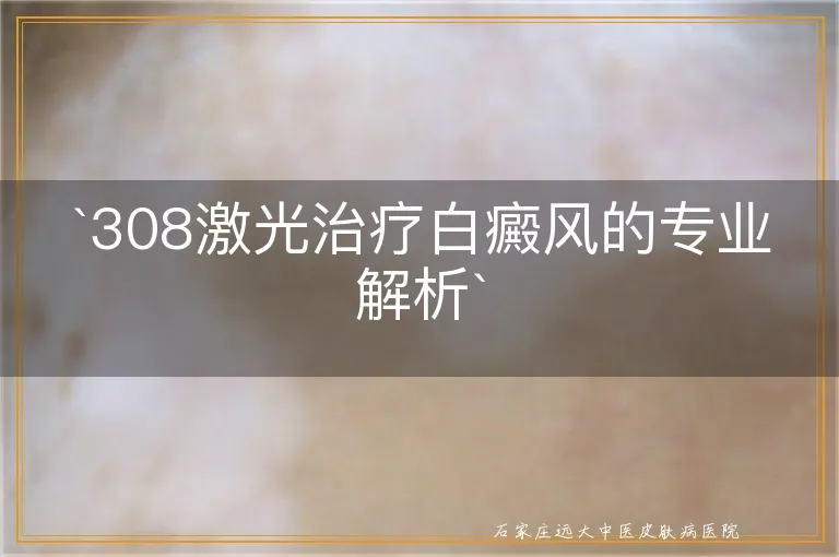 `308激光治疗白癜风的专业解析`