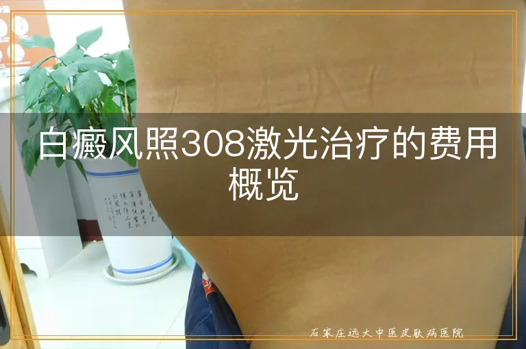 白癜风照308激光治疗的费用概览