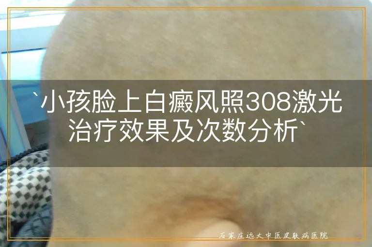 `小孩脸上白癜风照308激光治疗效果及次数分析`