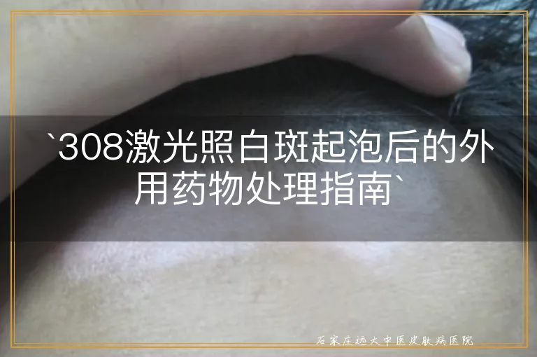 `308激光照白斑起泡后的外用药物处理指南`