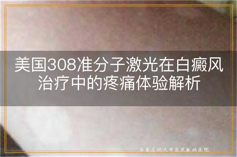 美国308准分子激光在白癜风治疗中的疼痛体验解析