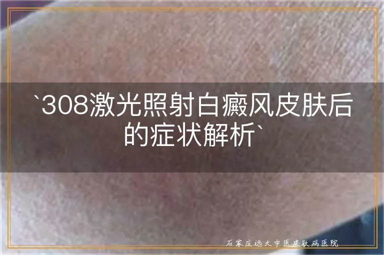 `308激光照射白癜风皮肤后的症状解析`